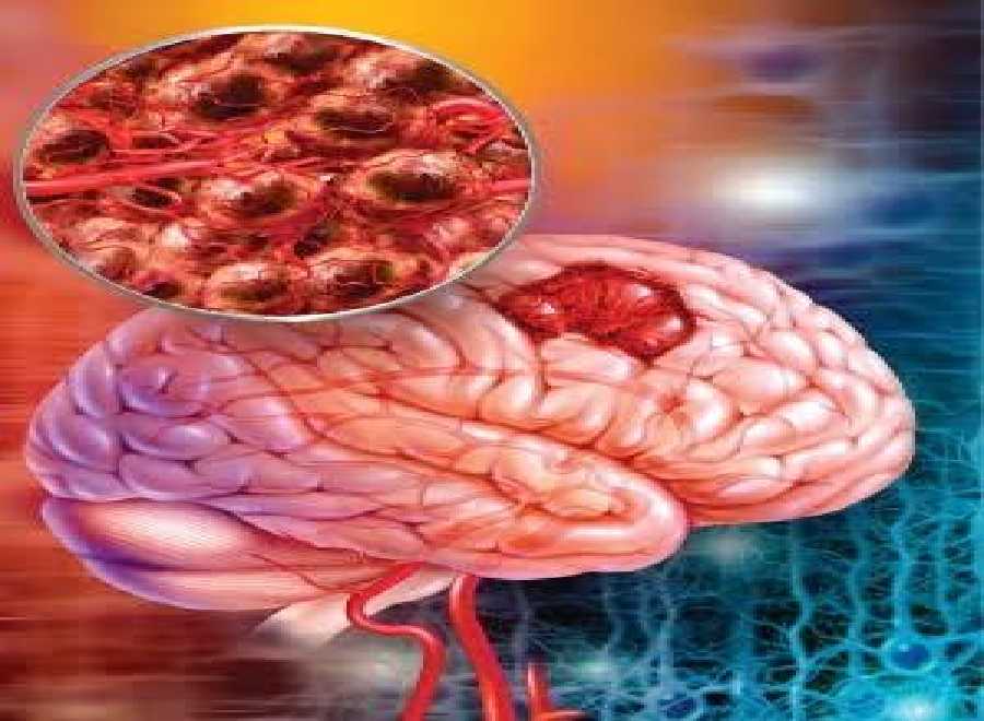 Awas, Beberapa Hal Ini Adalah Gejala Tumor yang Kerap Terabaikan