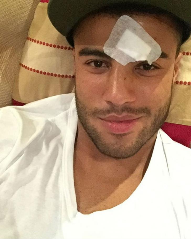 Patah Hidung, Model Tampan Ini Pakai Topeng Pelindung