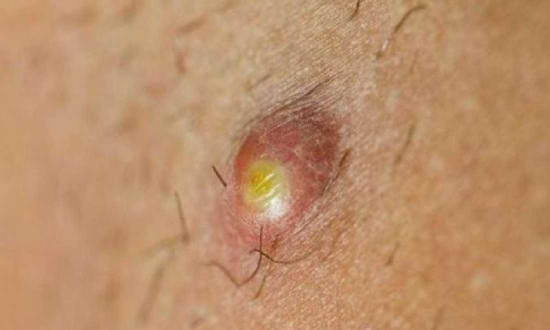 Kalau Ada Benjolan Seperti Bisul Begini, Maka Itu Tumor
