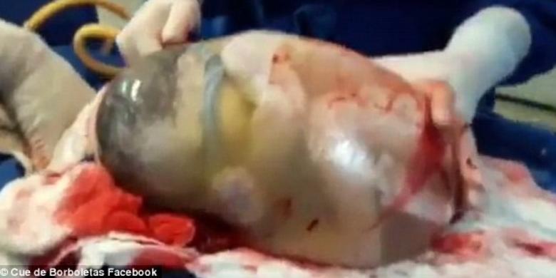 Kejadian Langka, Bayi Layir dengan Kantung Ketuban, 6,5 Juta Orang Sudah Melihatnya